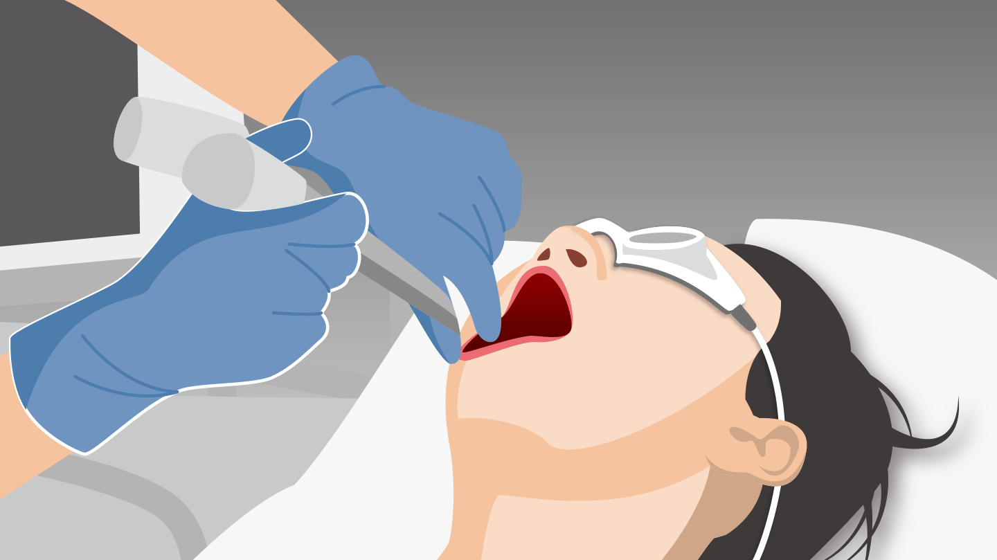 スマイルリフト(表情筋引き締め)