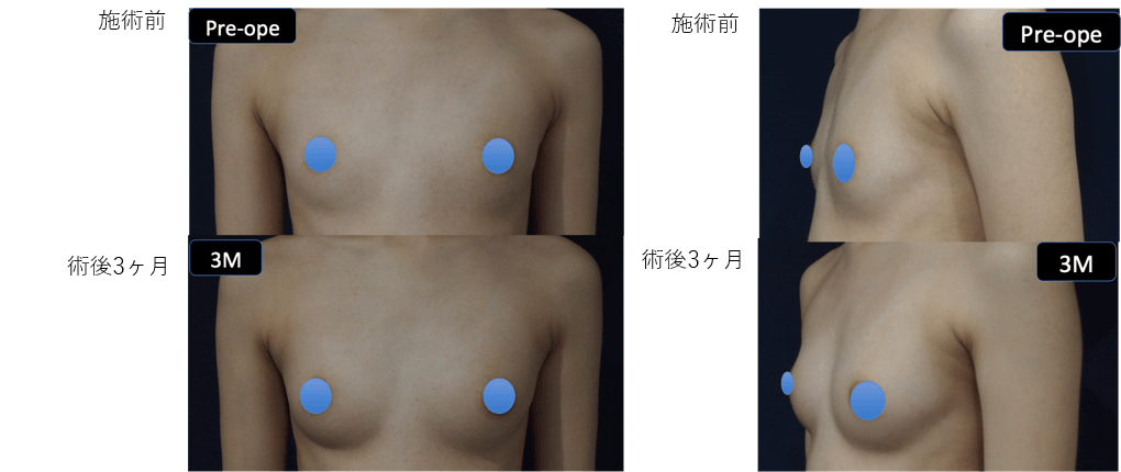 ダイオードレーザー脂肪注入豊胸術症例その１ | 施術前から１ヶ月後の経過観察(PC版)