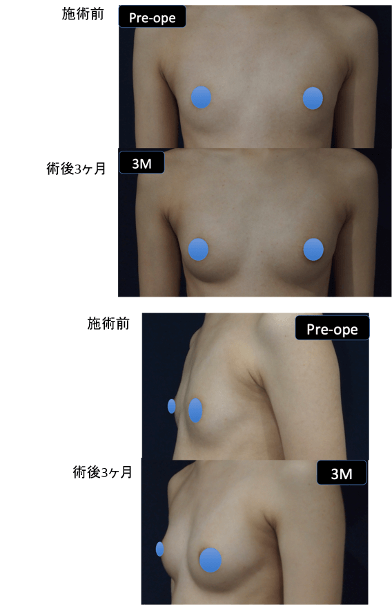 ダイオードレーザー脂肪注入豊胸術症例その１ | 施術前から１ヶ月後の経過観察(SP版)