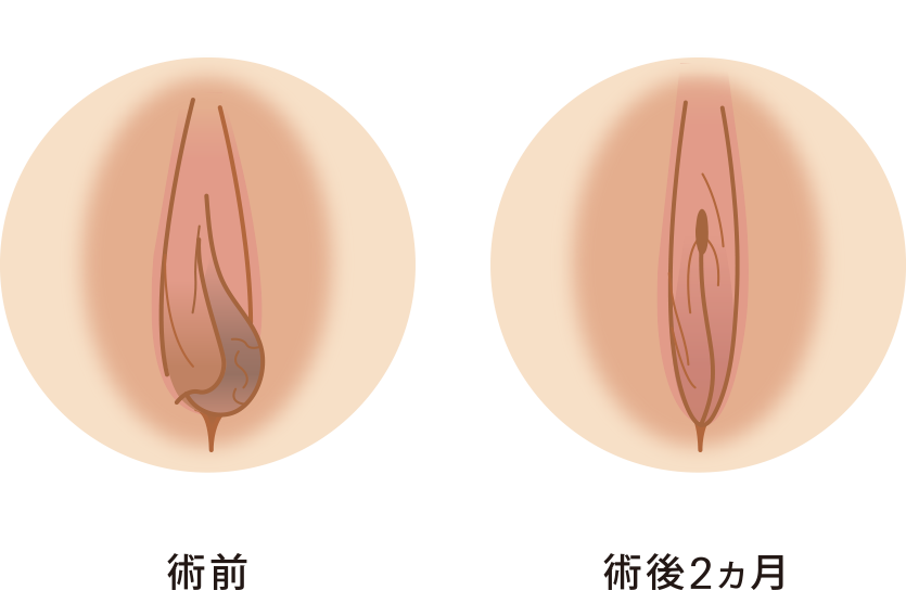 小陰唇縮小セット症例イメージ５