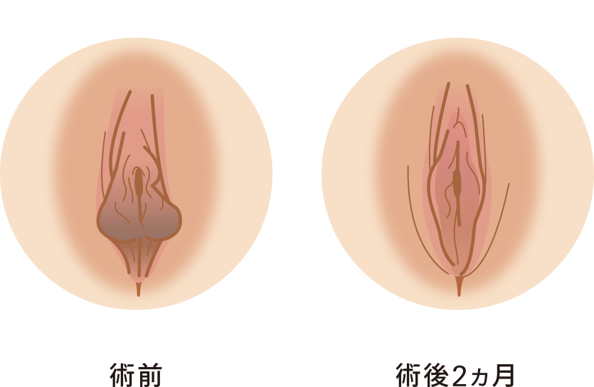 小陰唇縮小セット症例イメージ２（小陰唇縮小+副皮除去+クリトリス包茎）