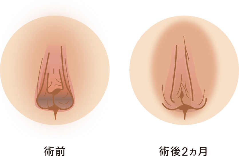 小陰唇縮小セット症例イメージ１（小陰唇縮小+副皮除去+クリトリス包茎）