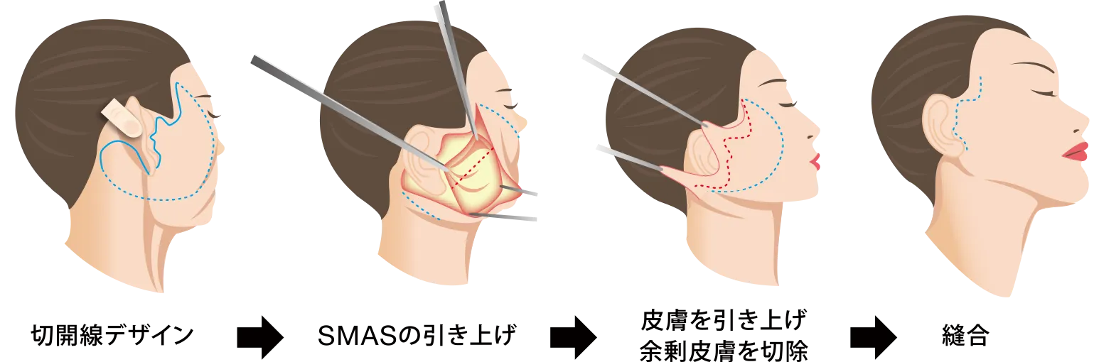 SMAS法フェイスリフト
