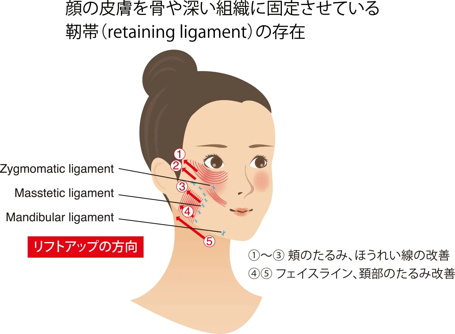 Deep planeフェイスネックリフト