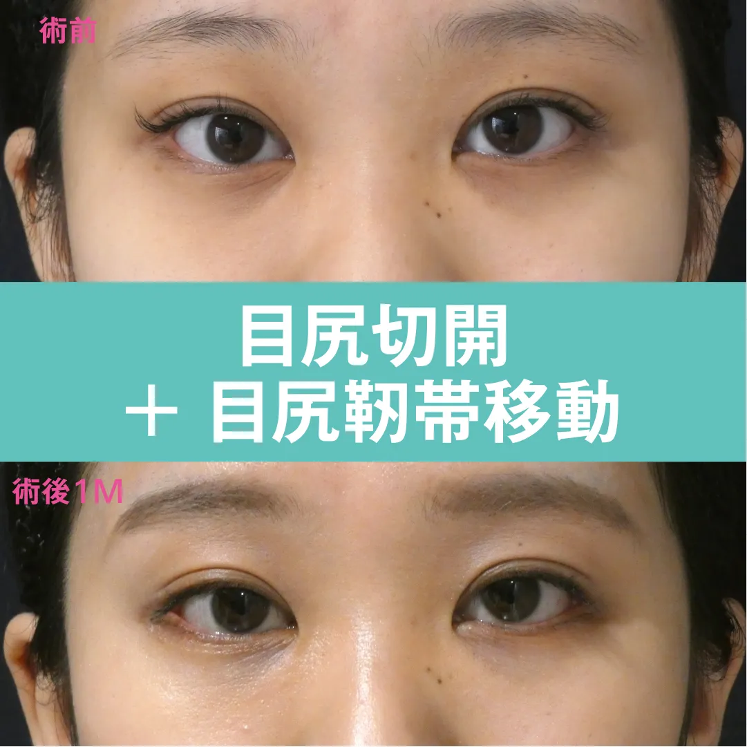 目尻切開＋目尻靭帯移動のビフォー・アフター症例その2 | 施術前と術後の正面経過観察(PC版)