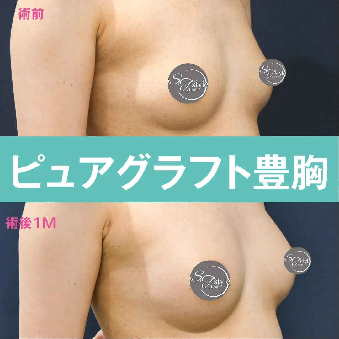 ピュアグラフト豊胸のビフォー・アフター症例その１ | 施術前から１ヶ月後の斜め経過観察(PC版)