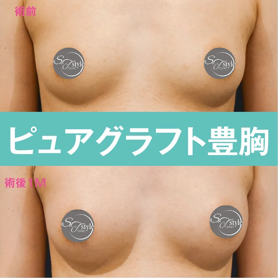 ピュアグラフト豊胸のビフォー・アフター症例その１ | 施術前から１ヶ月後の正面経過観察(PC版)