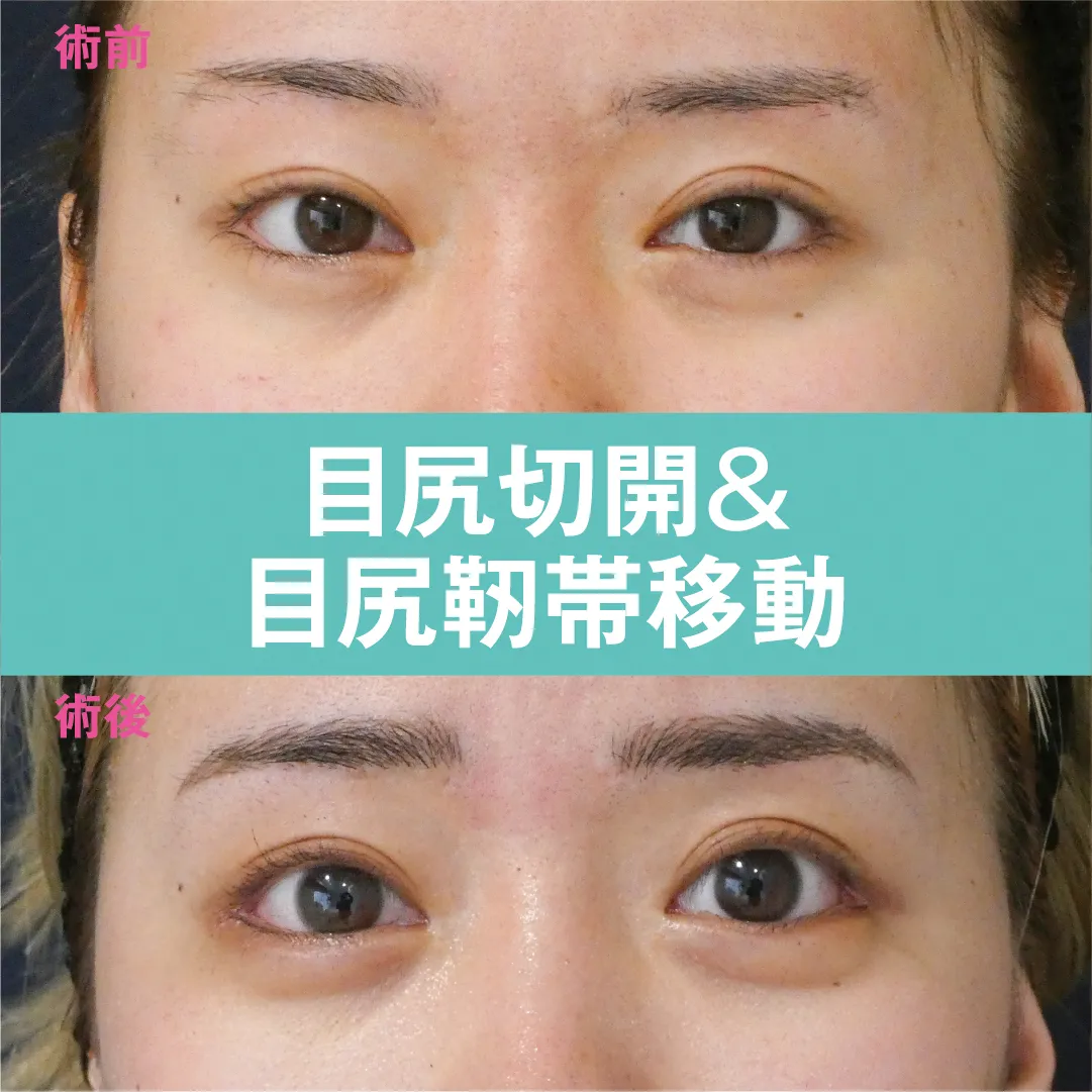 目尻切開＋目尻靭帯移動のビフォー・アフター症例その１ | 施術前と術後の正面経過観察(PC版)