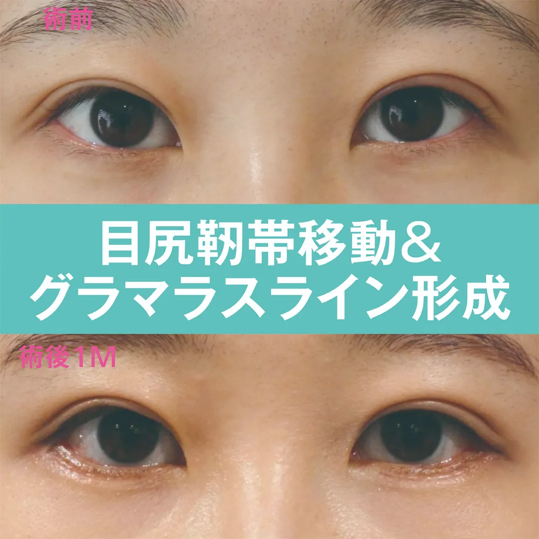 目尻切開＋目尻靭帯移動＋グラマラスライン形成のビフォー・アフター症例その１ | 施術前と術後の正面経過観察(PC版)