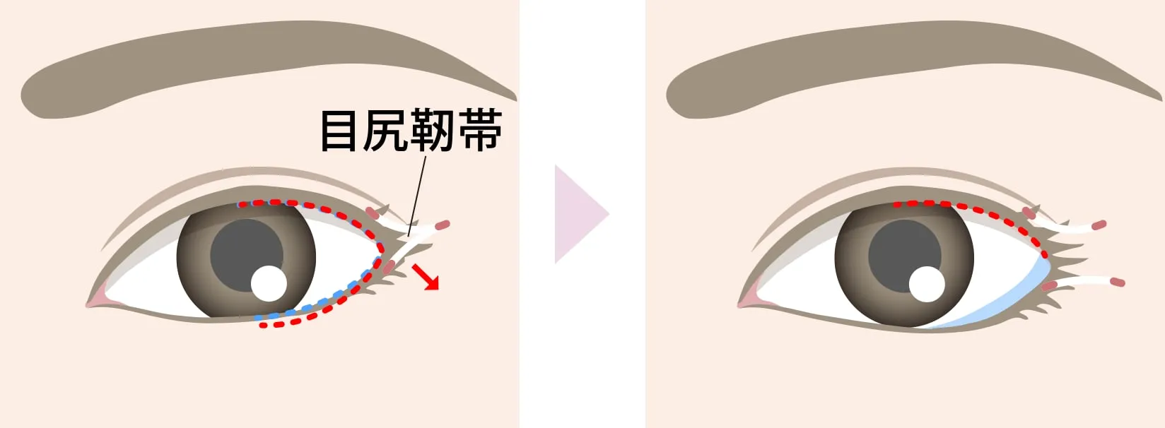 目尻靭帯移動