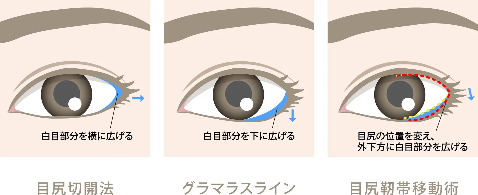 目尻施術の違い