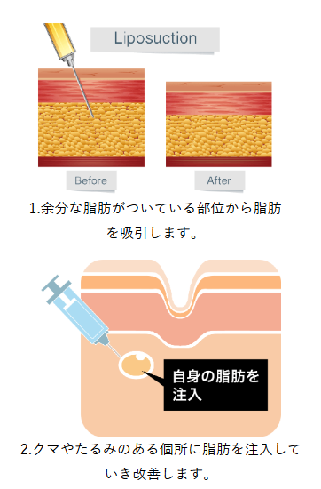 脂肪注入施術方法