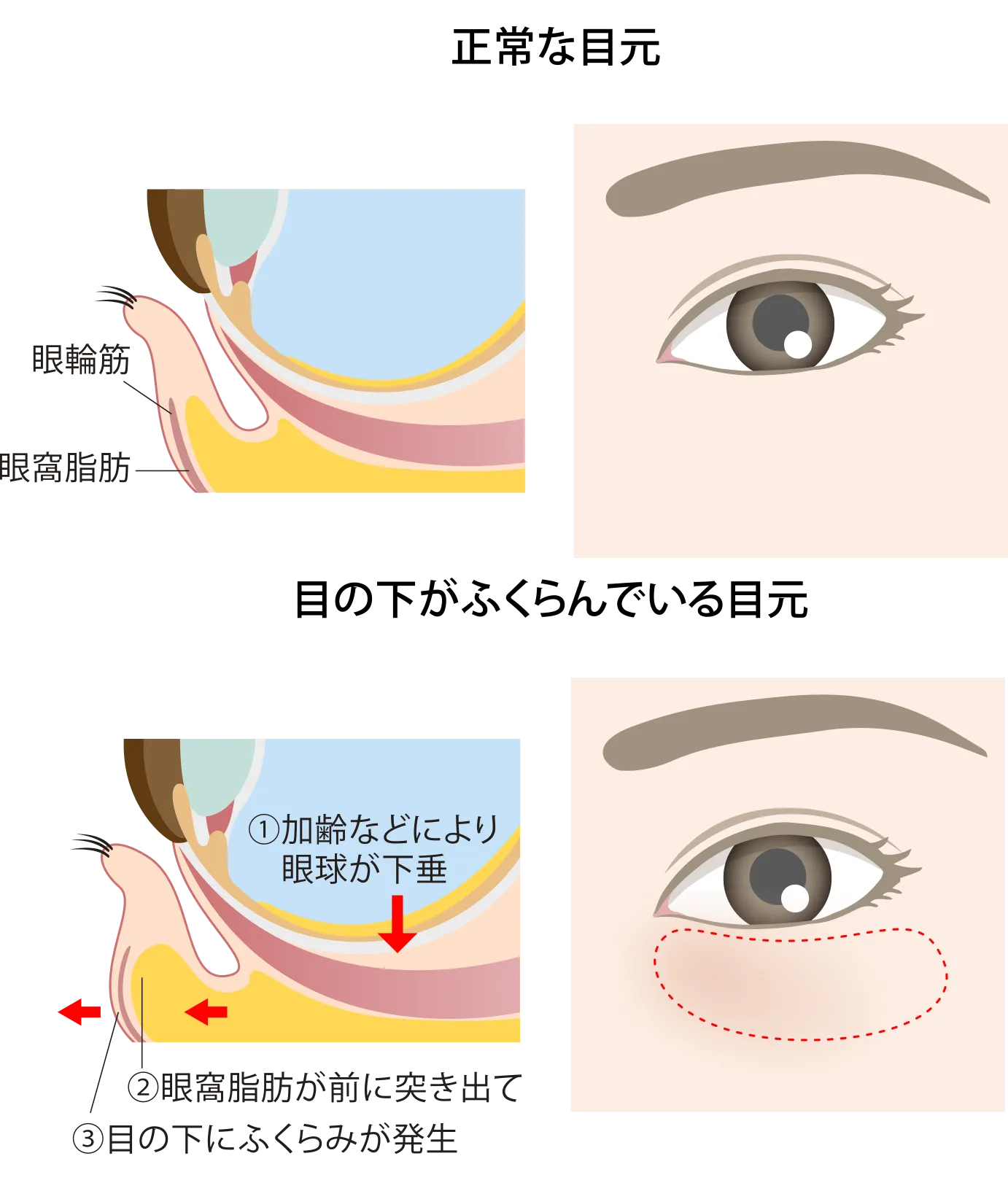 目の下のたるみイメージ