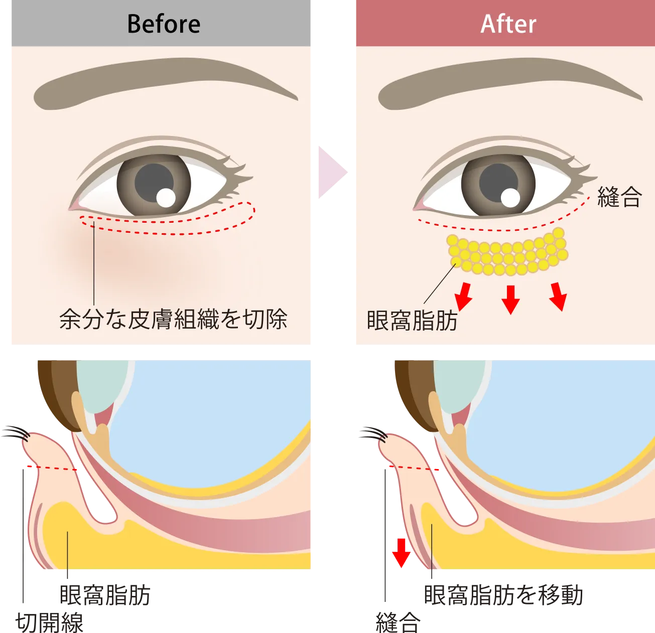 表ハムラ施術方法
