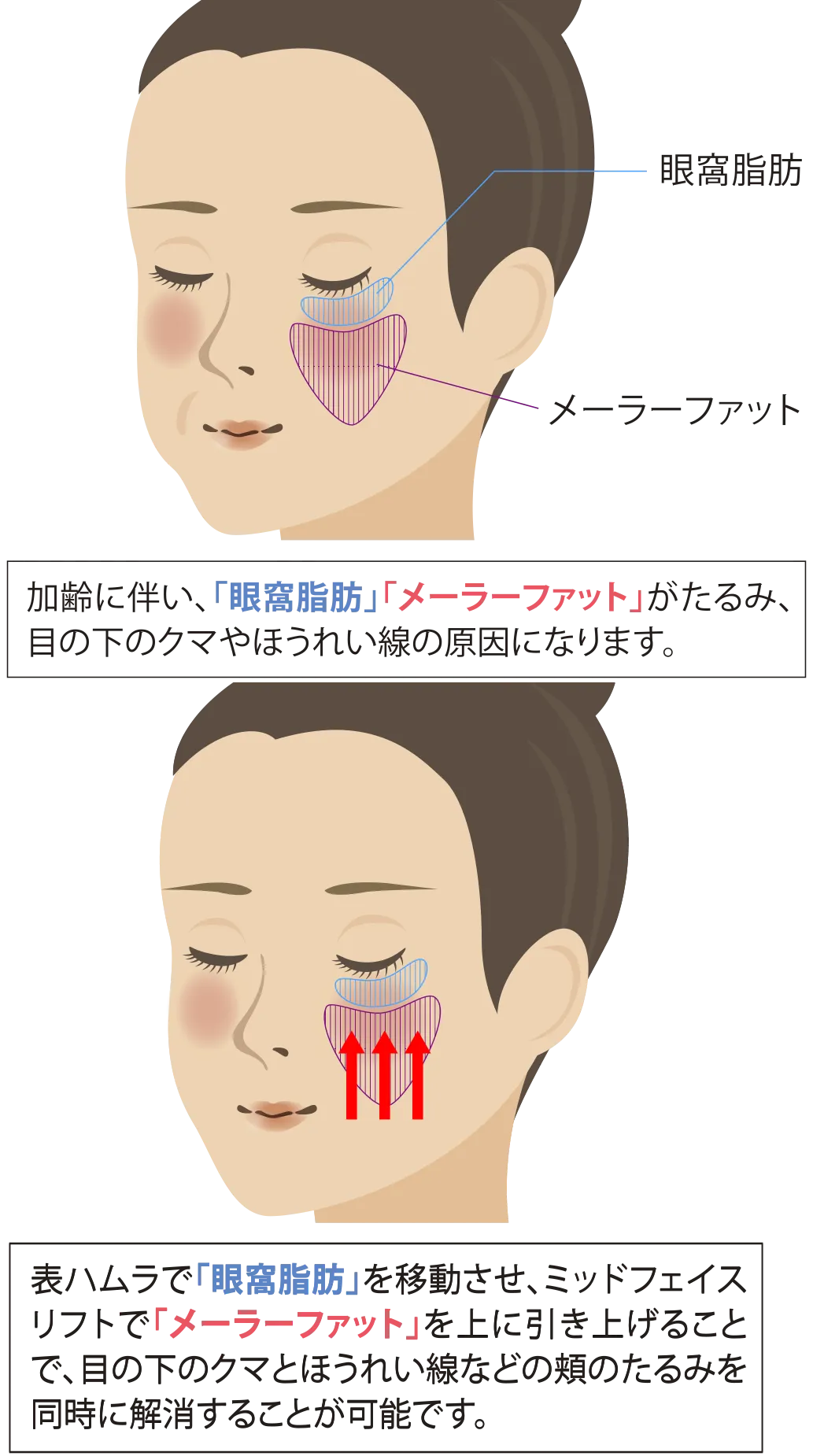 ミッドフェイスリフト