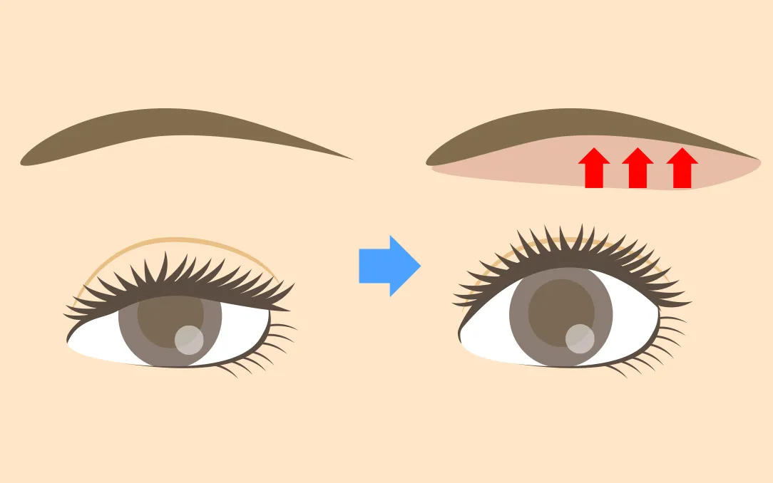 眉下切開(上眼瞼リフト)イメージ
