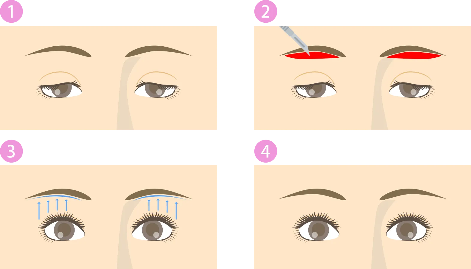 眉下切開(上眼瞼リフト)施術方法