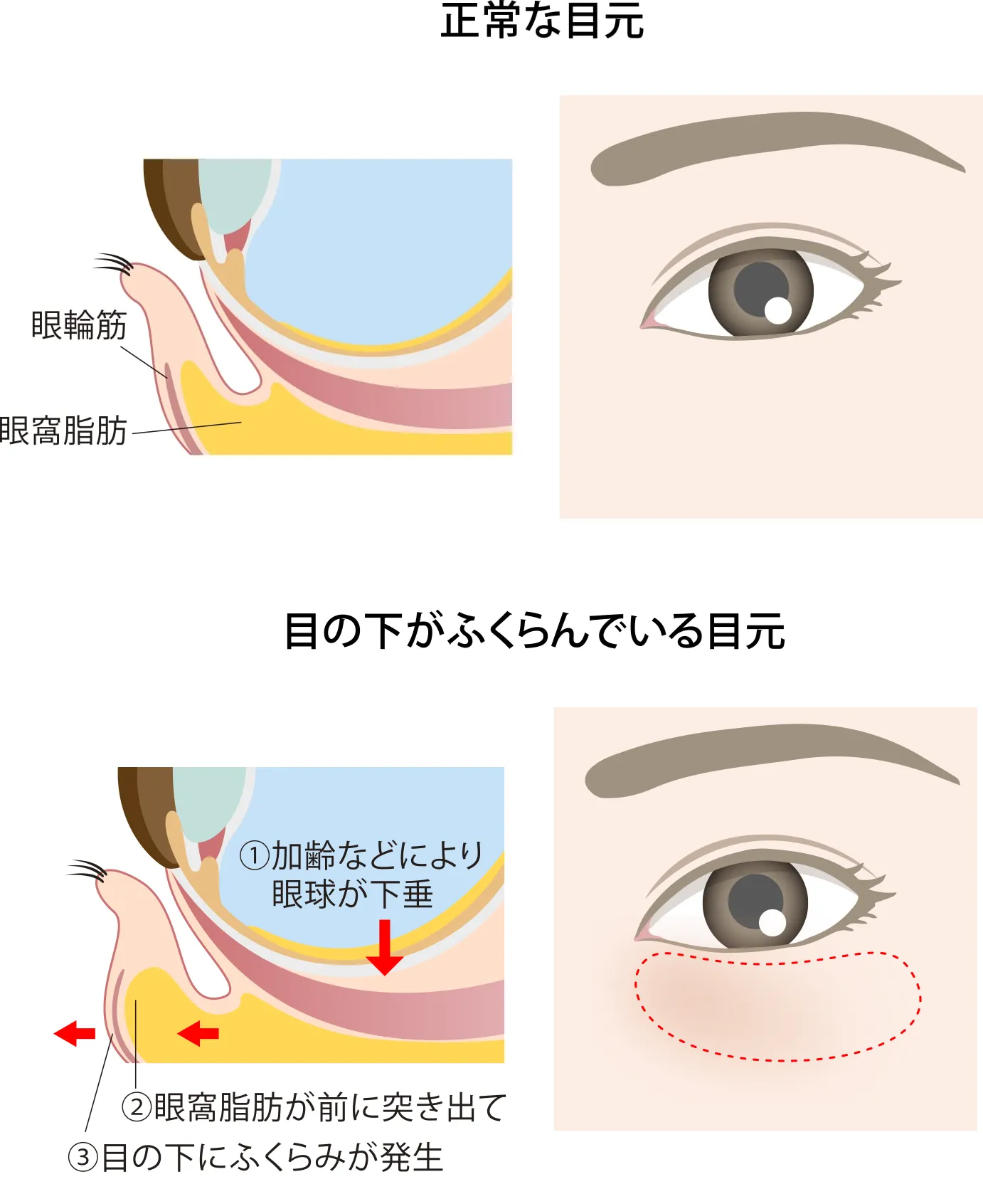 目の下のたるみイメージ