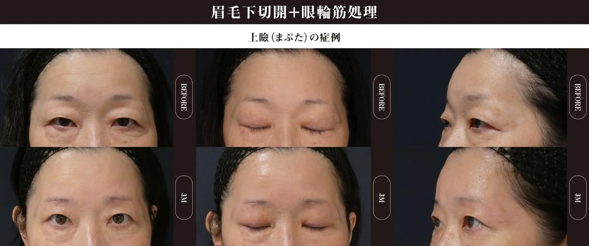 眉下切開(上眼瞼リフト)のビフォー・アフター症例その１ | 施術前と術後の正面経過観察(PC版)