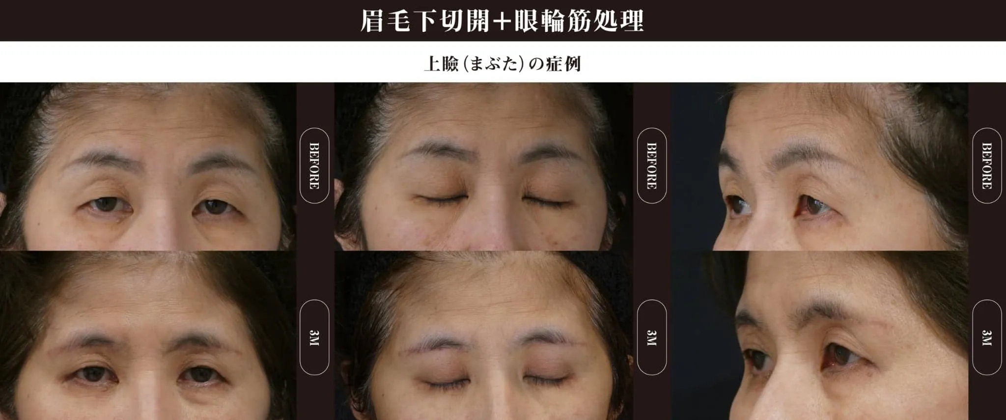 眉下切開(上眼瞼リフト)のビフォー・アフター症例その１ | 施術前と術後の正面経過観察(PC版)