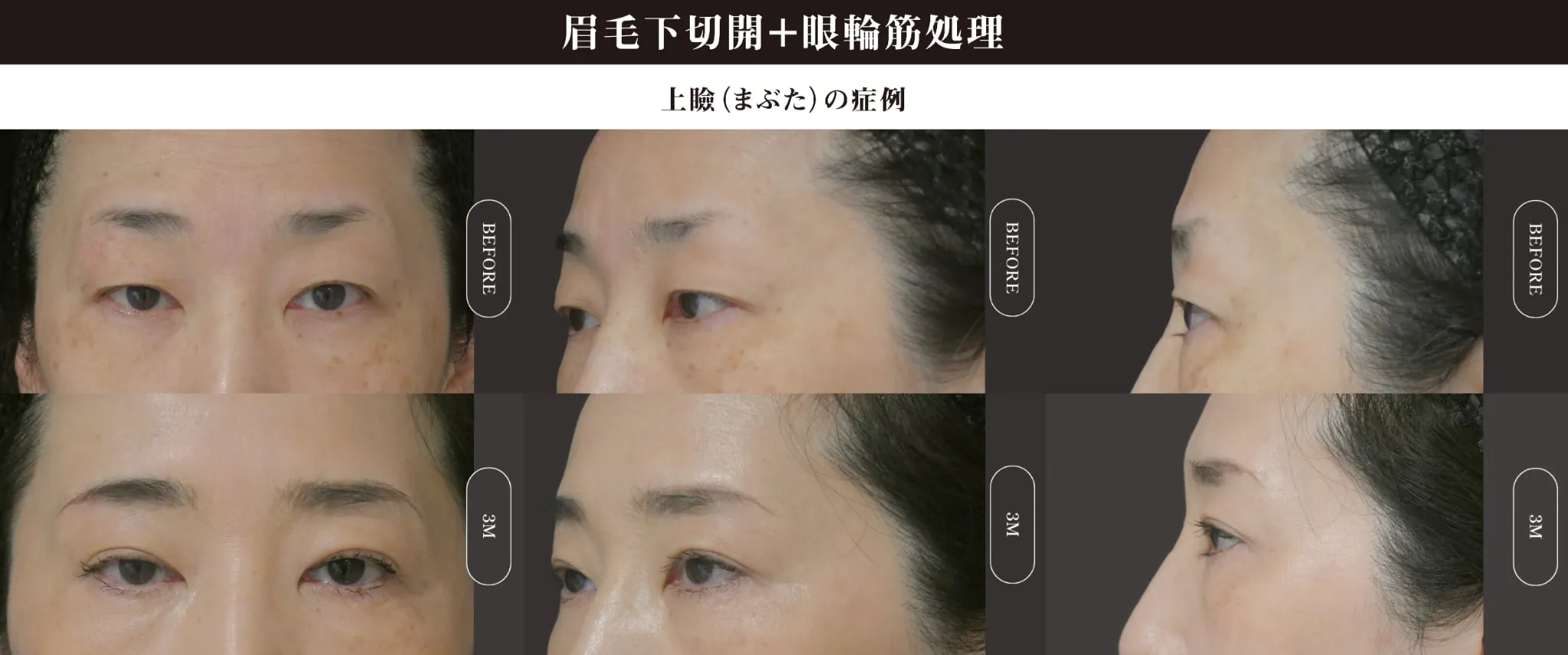 眉下切開(上眼瞼リフト)のビフォー・アフター症例その１ | 施術前と術後の正面経過観察(PC版)