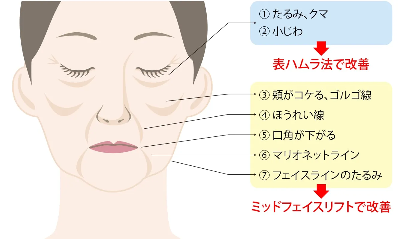 ミッドフェイスリフト