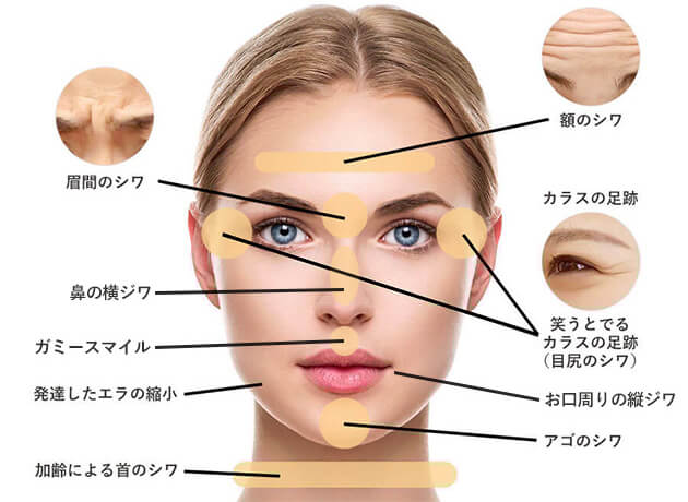 ボトックス注入 適応