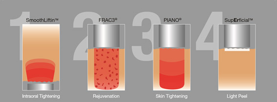 フォトナ4D　(Fotona4D)リフト