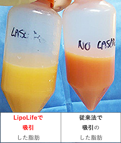 脂肪吸引された脂肪の比較例