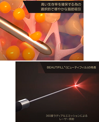 高い生存率を確保する為の選択的で穏やかな脂肪吸引