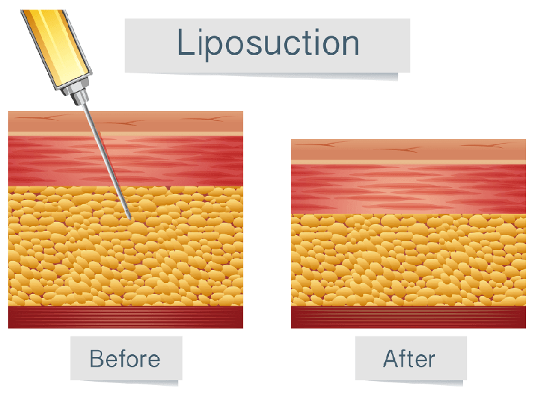 余分な脂肪がついている部位から吸引
