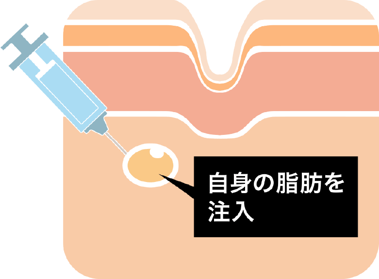 自身の脂肪注入