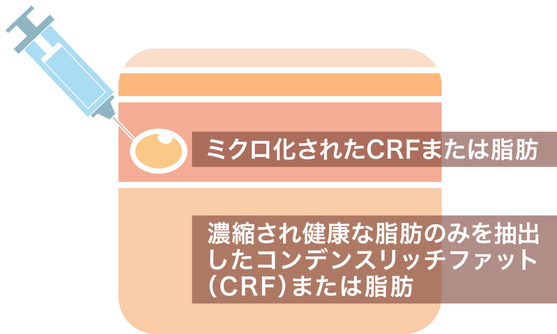 自身の脂肪注入