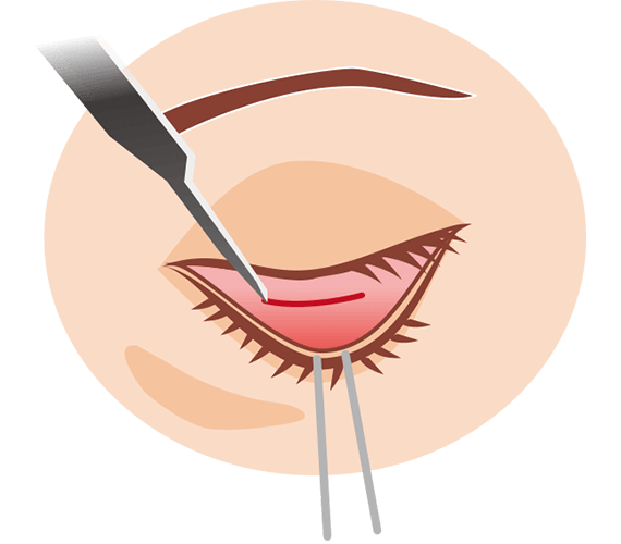 下まぶたの内側を切開