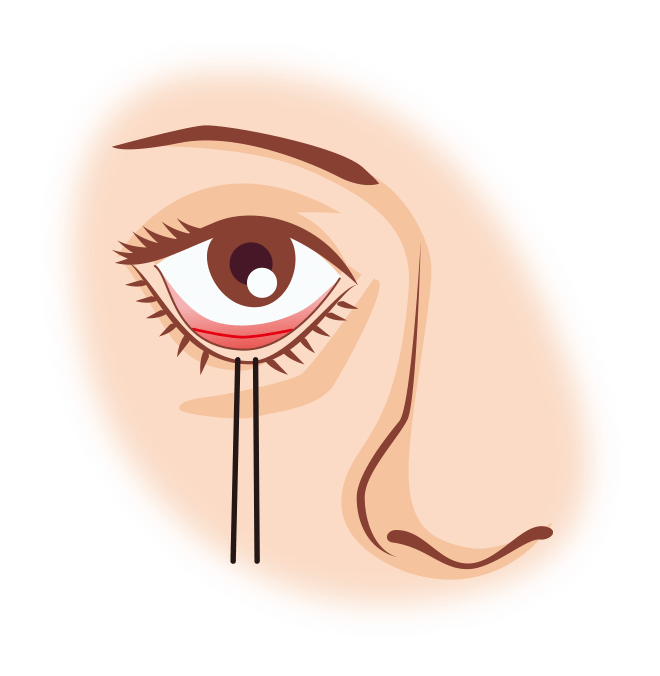 下まぶたの内側を切開