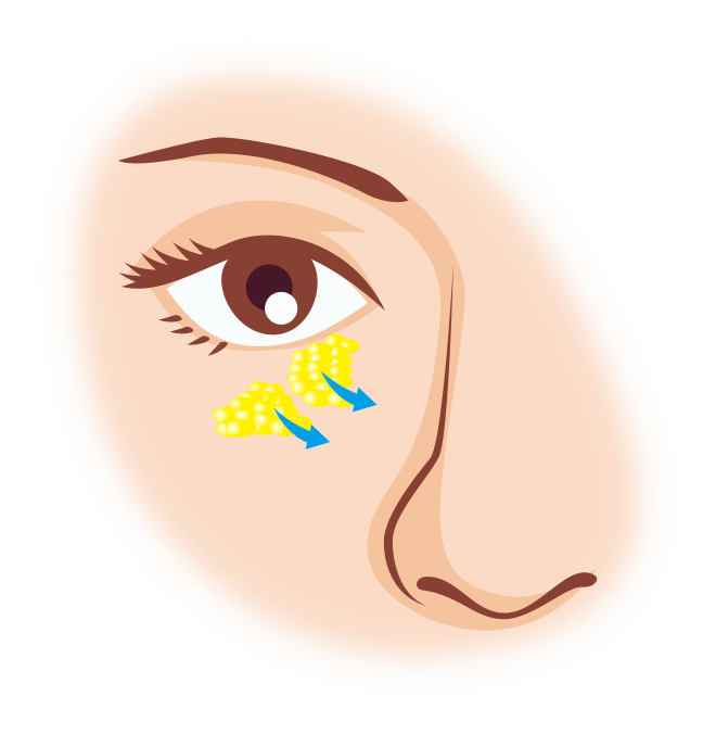 過剰な脂肪を移動させ平坦に