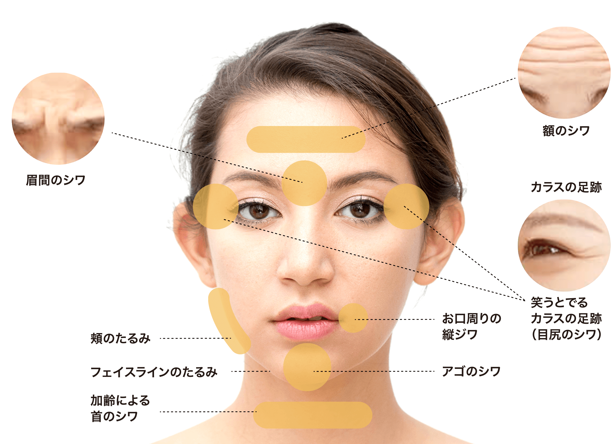 しわ・たるみの発生する箇所