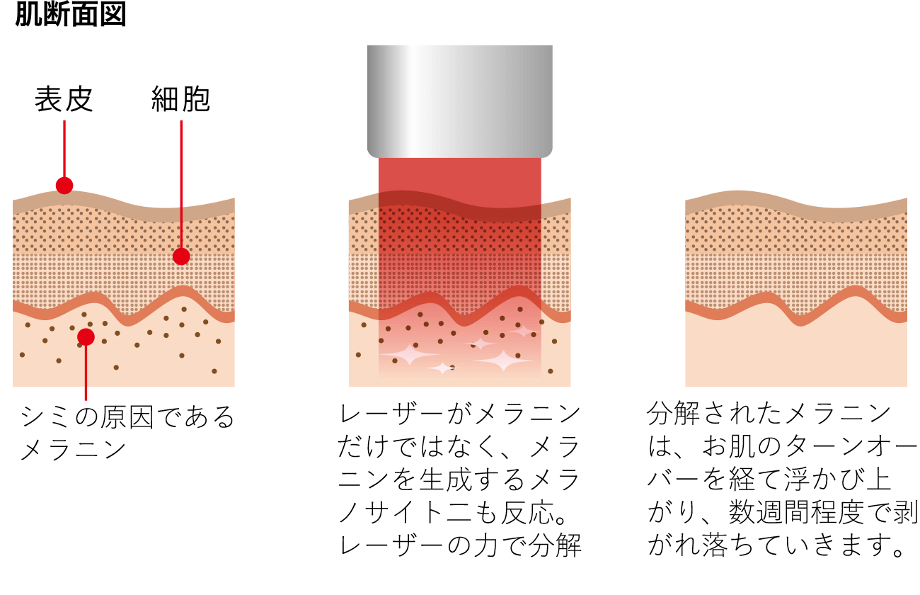 QスイッチYAGレーザー