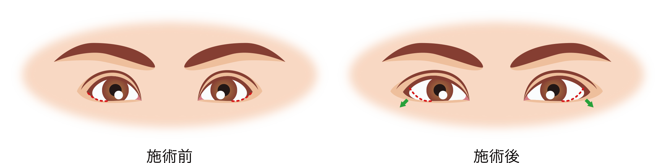 グラマラスライン形成