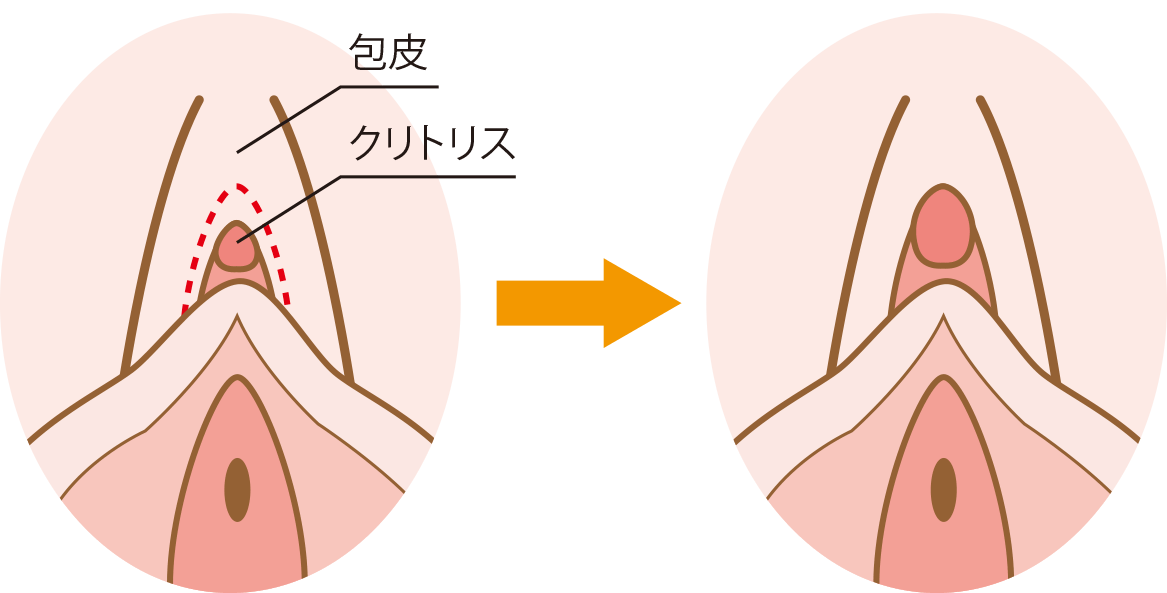 クリトリス包茎