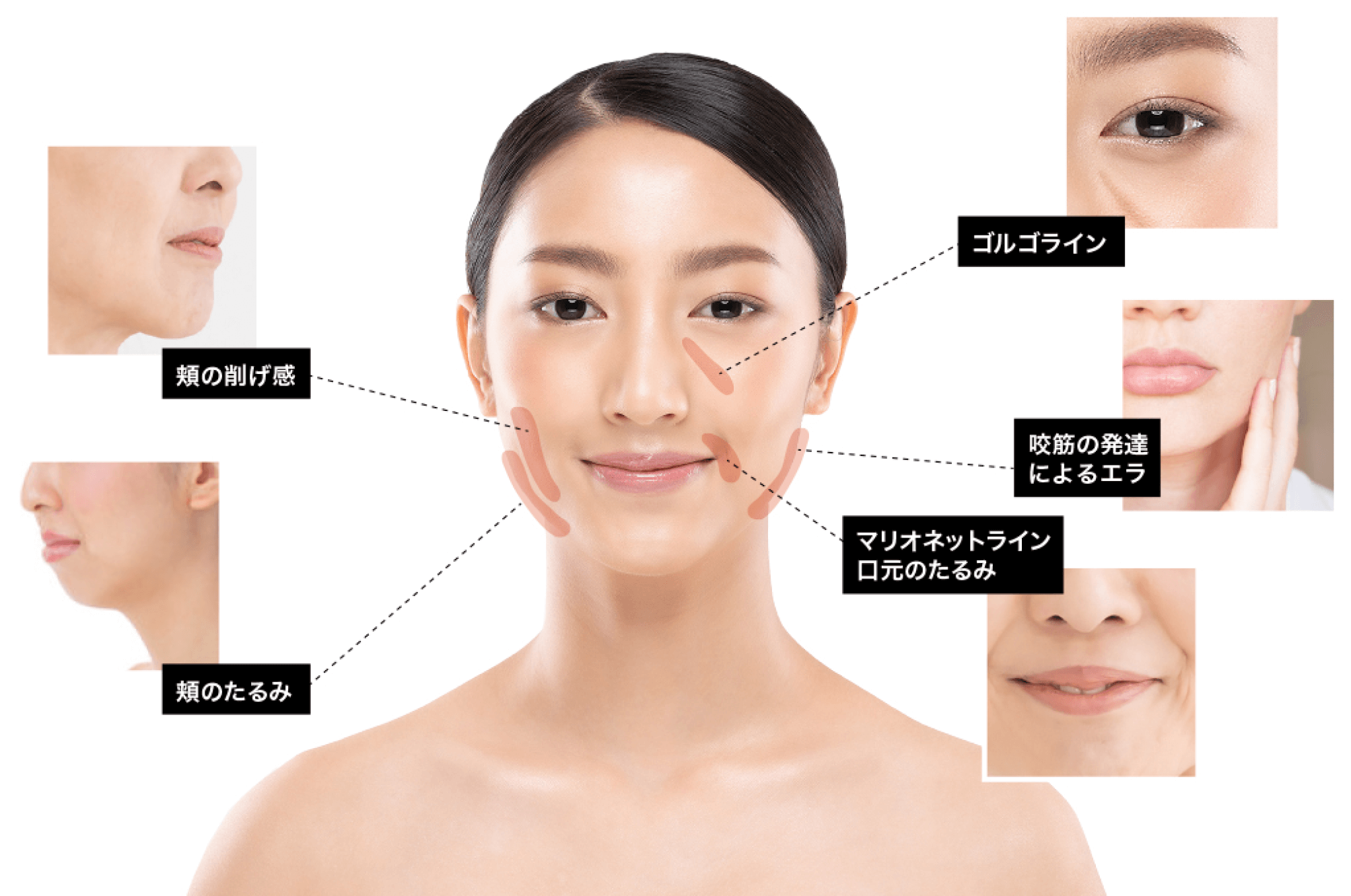 輪郭・小顔施術の対象箇所