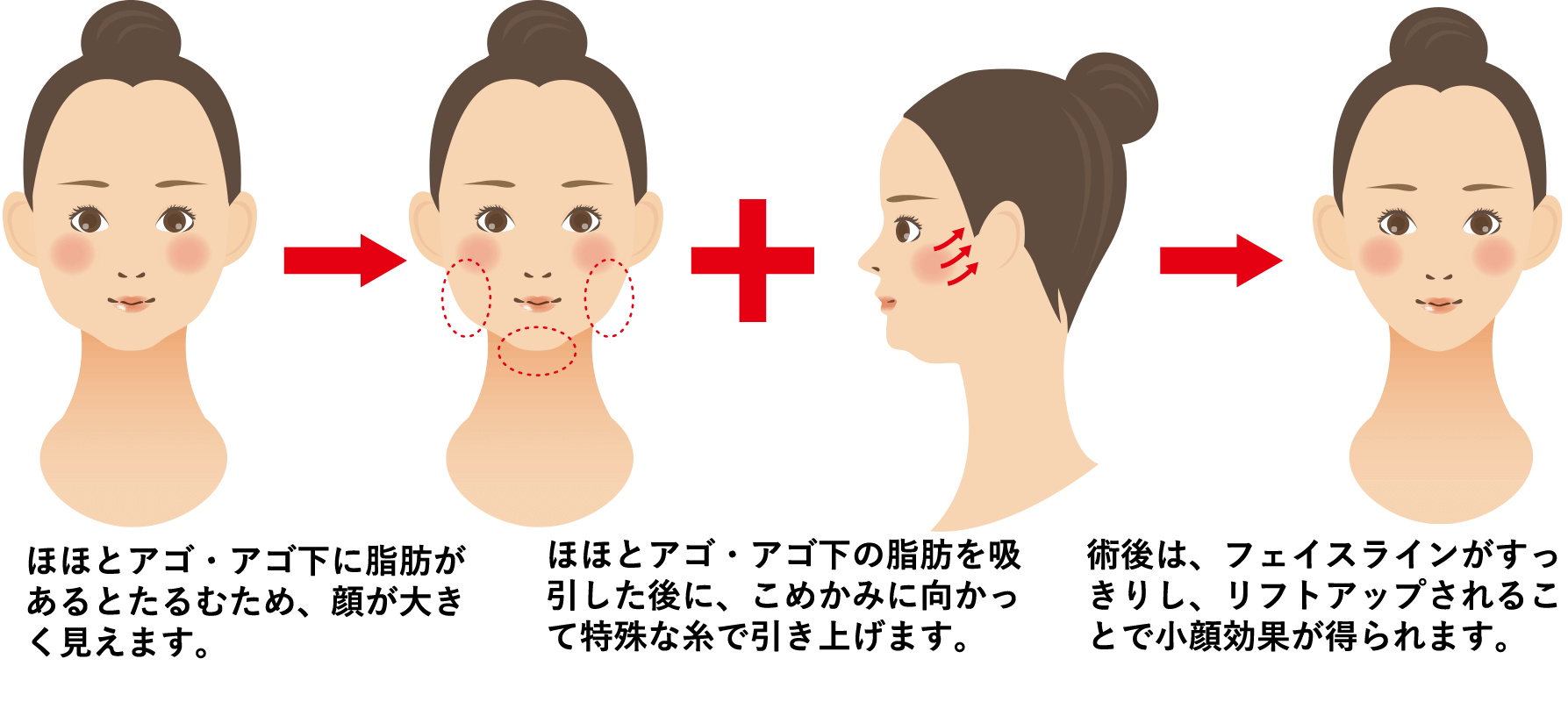 ほほアゴ脂肪吸引+糸リフトアップ