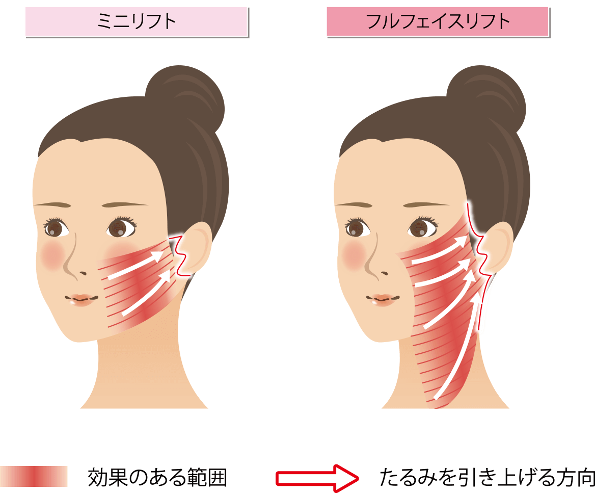 フェイスリフト