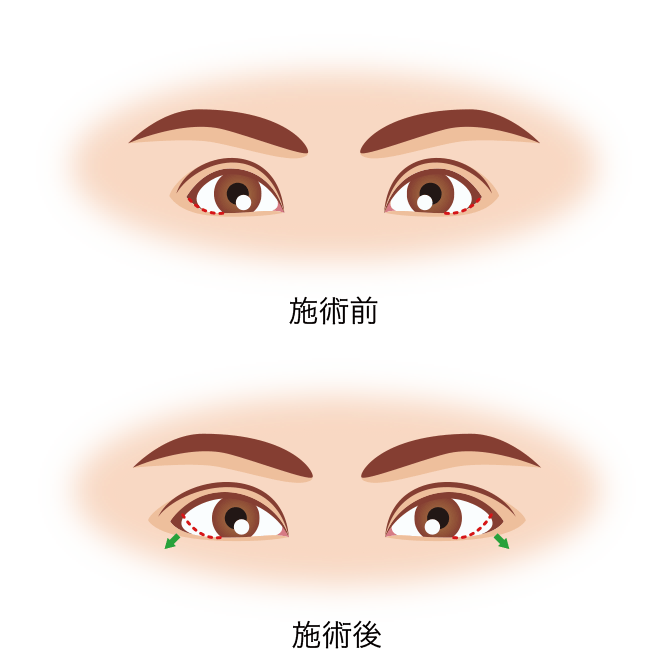 グラマラスライン形成