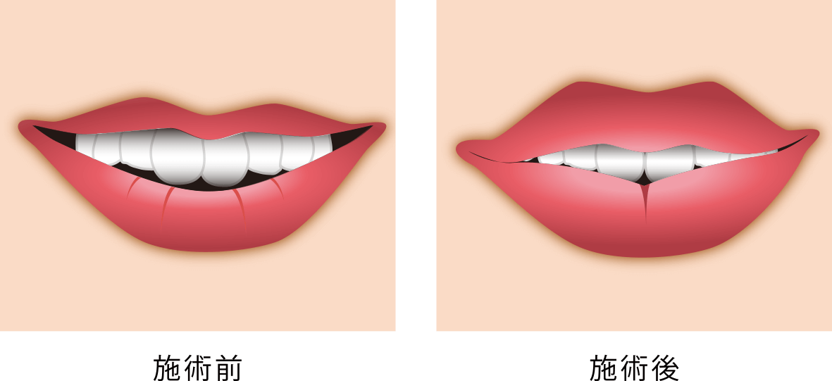 余分な脂肪がついている部位から吸引
