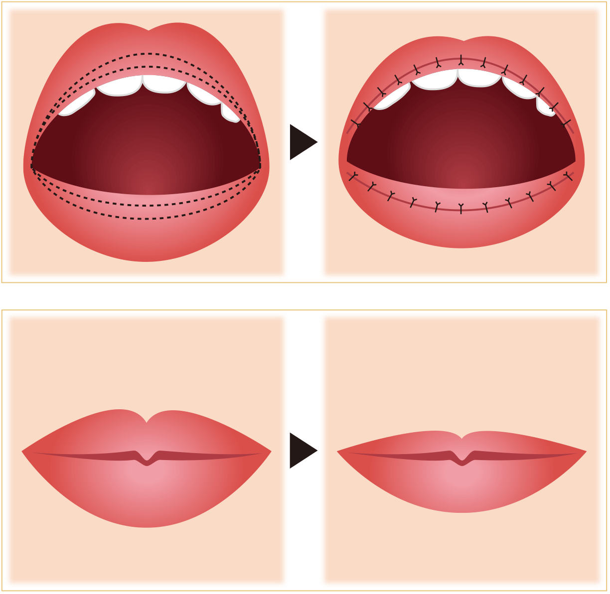 余分な脂肪がついている部位から吸引