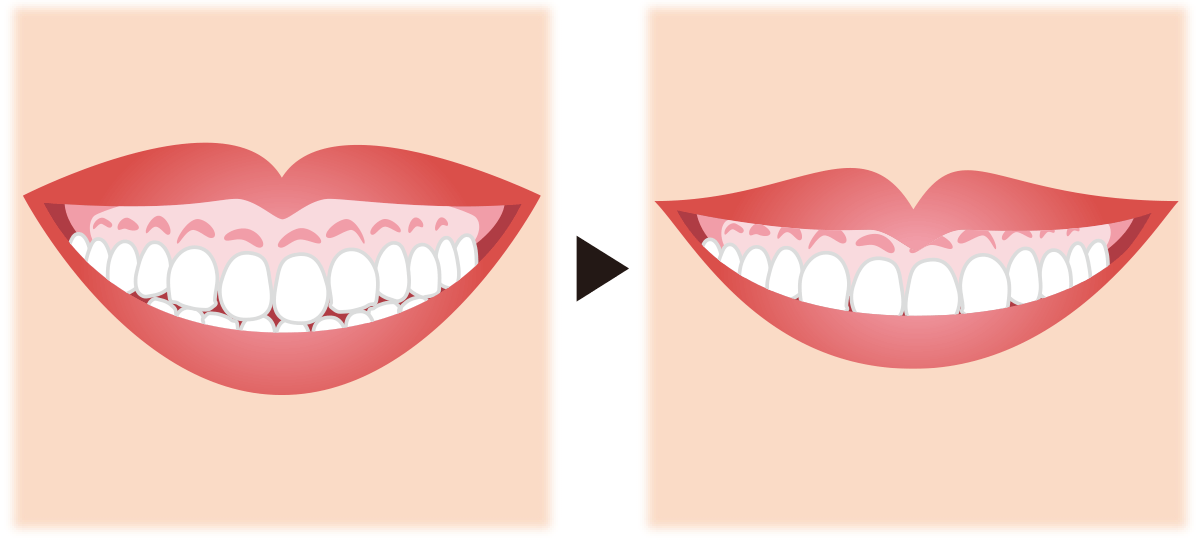 ガミースマイル