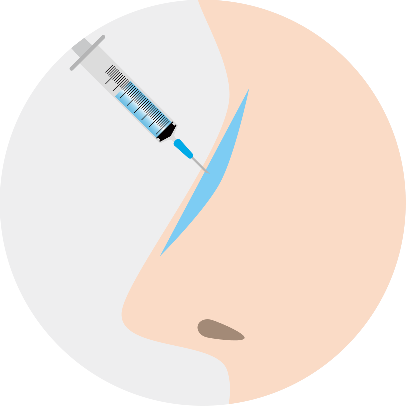 隆鼻術(注射注入)