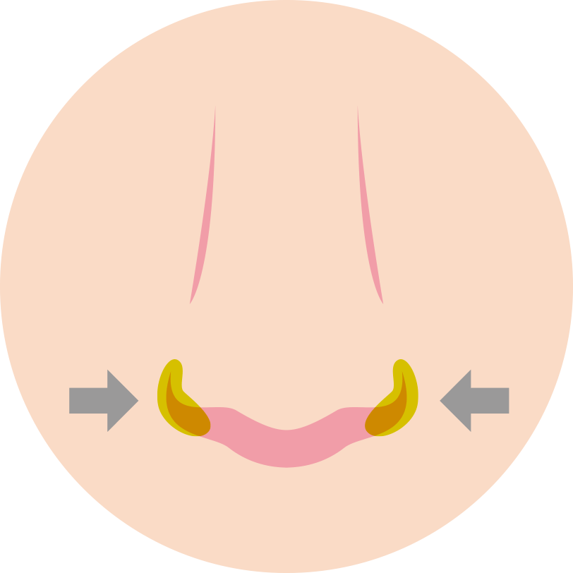 小鼻縮小(鼻翼縮小)