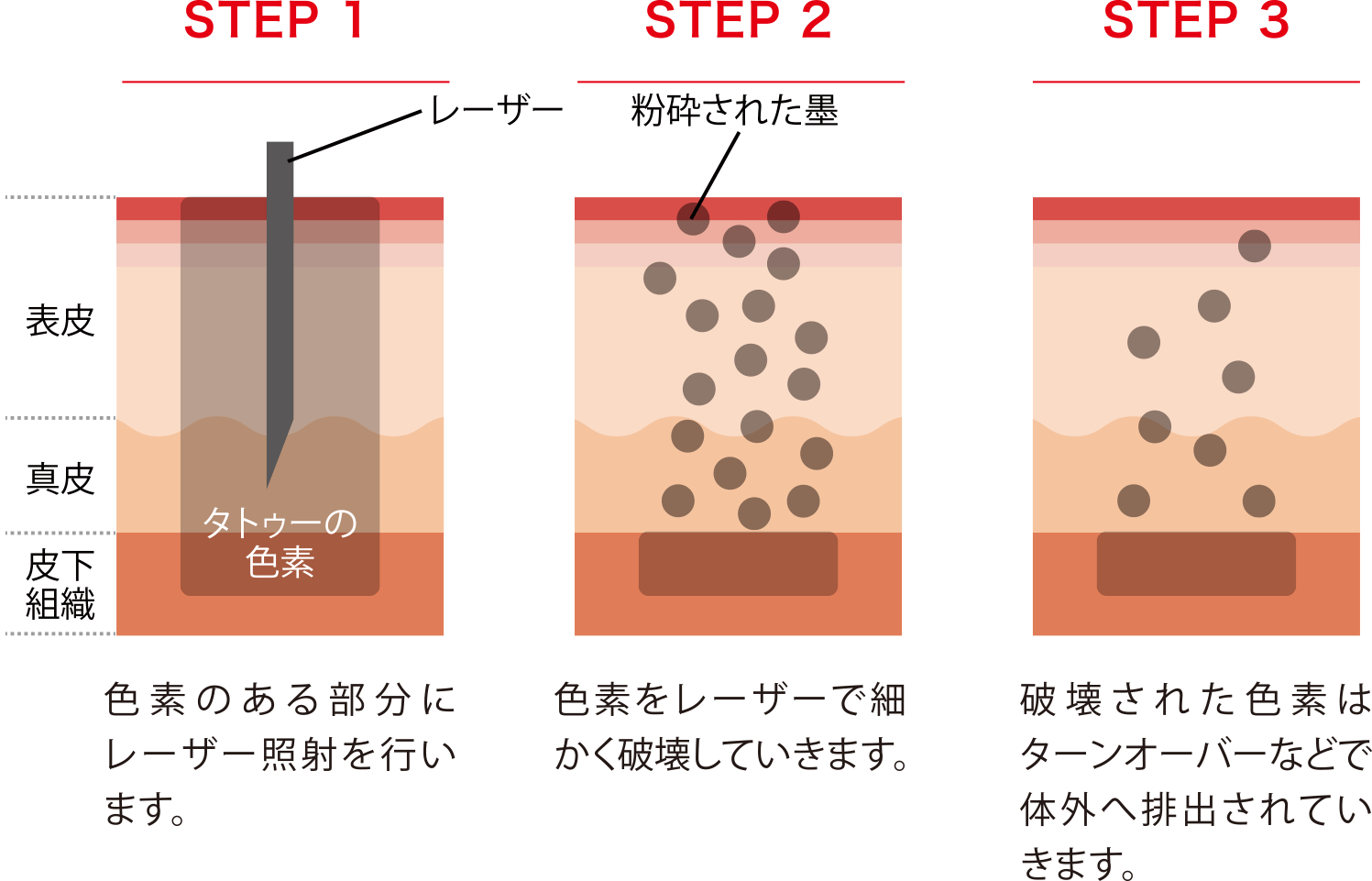 QスイッチYAGレーザー